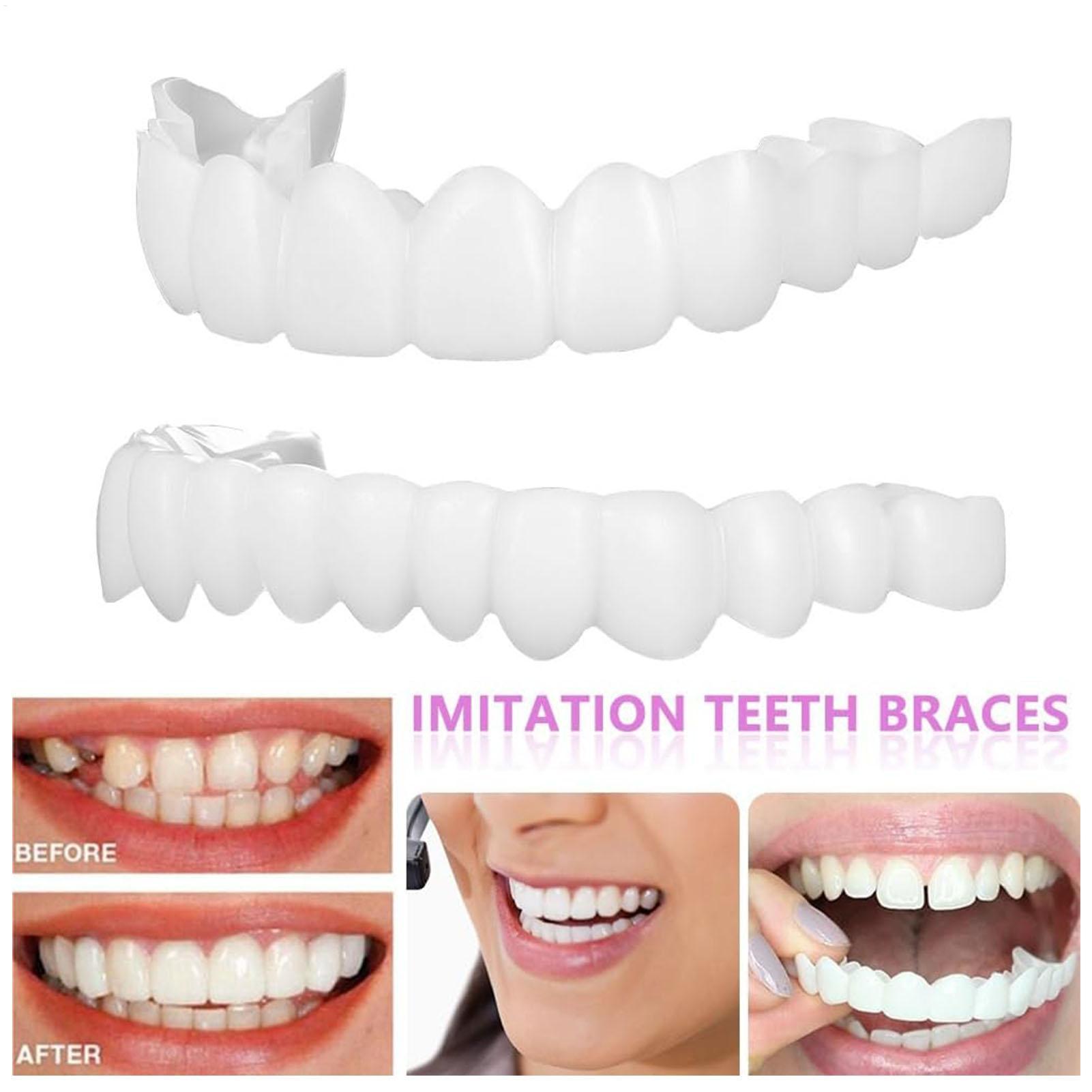 Teeth Whitening With Braces - Copertura Dentale Superiore e Inferiore per
