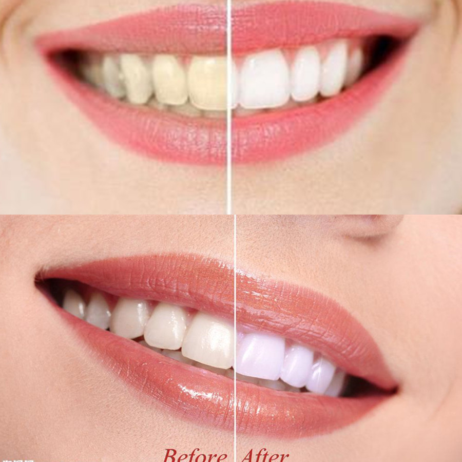 Denti di carbone di bambù dent - Teeth Whitening From Home recensione e prezzo