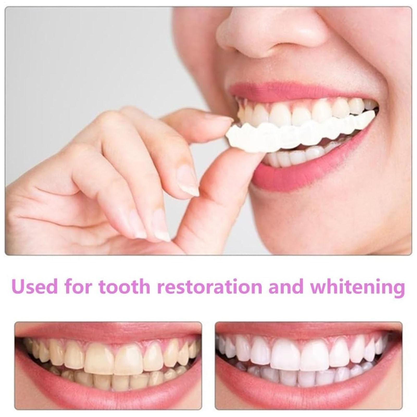 Copertura Dentale Superiore e  - Teeth Whitening With Braces recensione e prezzo