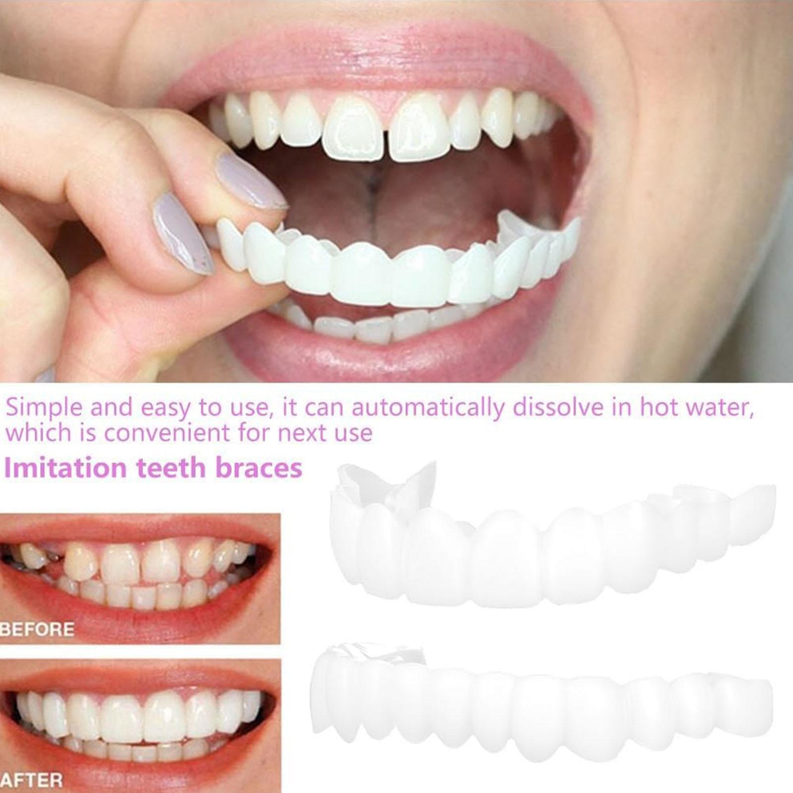Copertura Dentale Superiore e  - Teeth Whitening With Braces recensione e prezzo