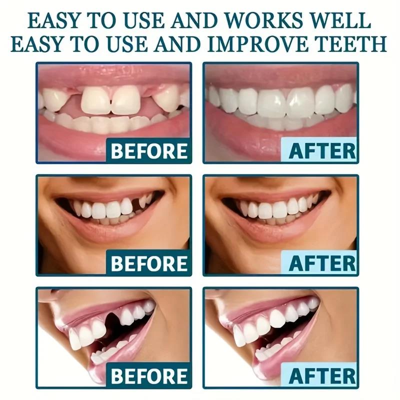 Nuove Faccette Dentali Cosmeti - Teeth Whitening With Braces recensione e prezzo