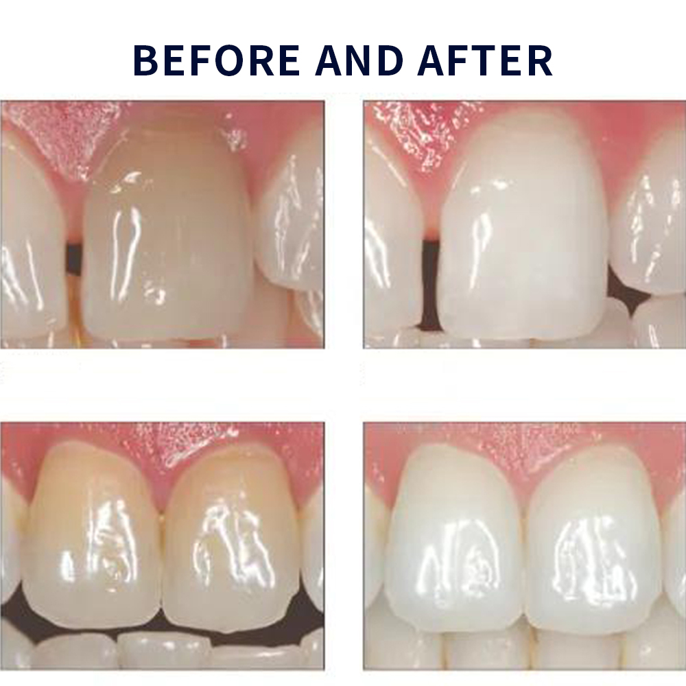 Opalescence Whitening 20% PF 2 - Teeth Whitening From Home recensione e prezzo