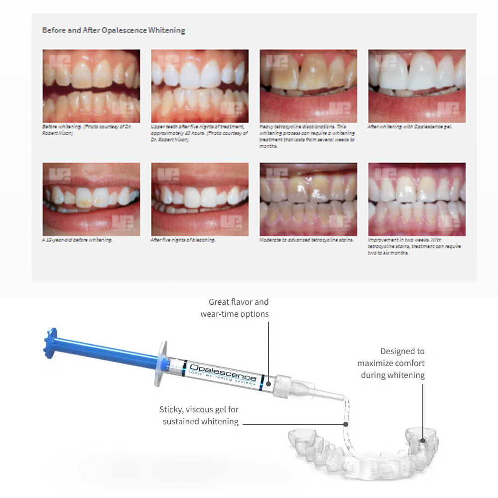 Opalescence Whitening 20% PF 2 - Teeth Whitening From Home recensione e prezzo