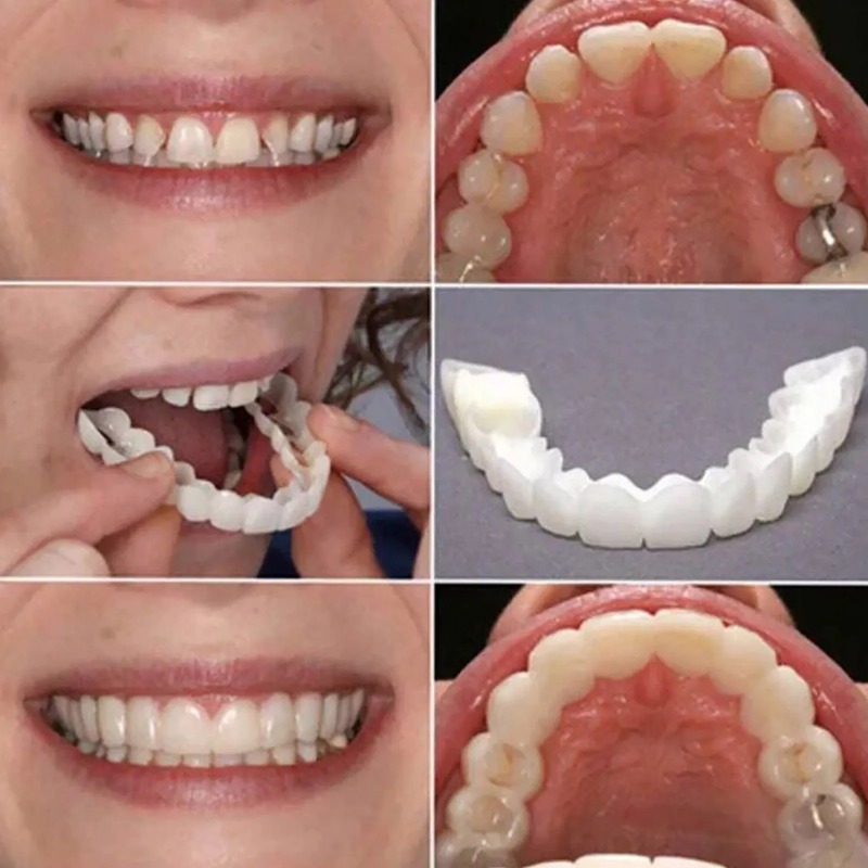 Faccette Dentali Sbiancanti Is - Teeth Whitening With Braces recensione e prezzo