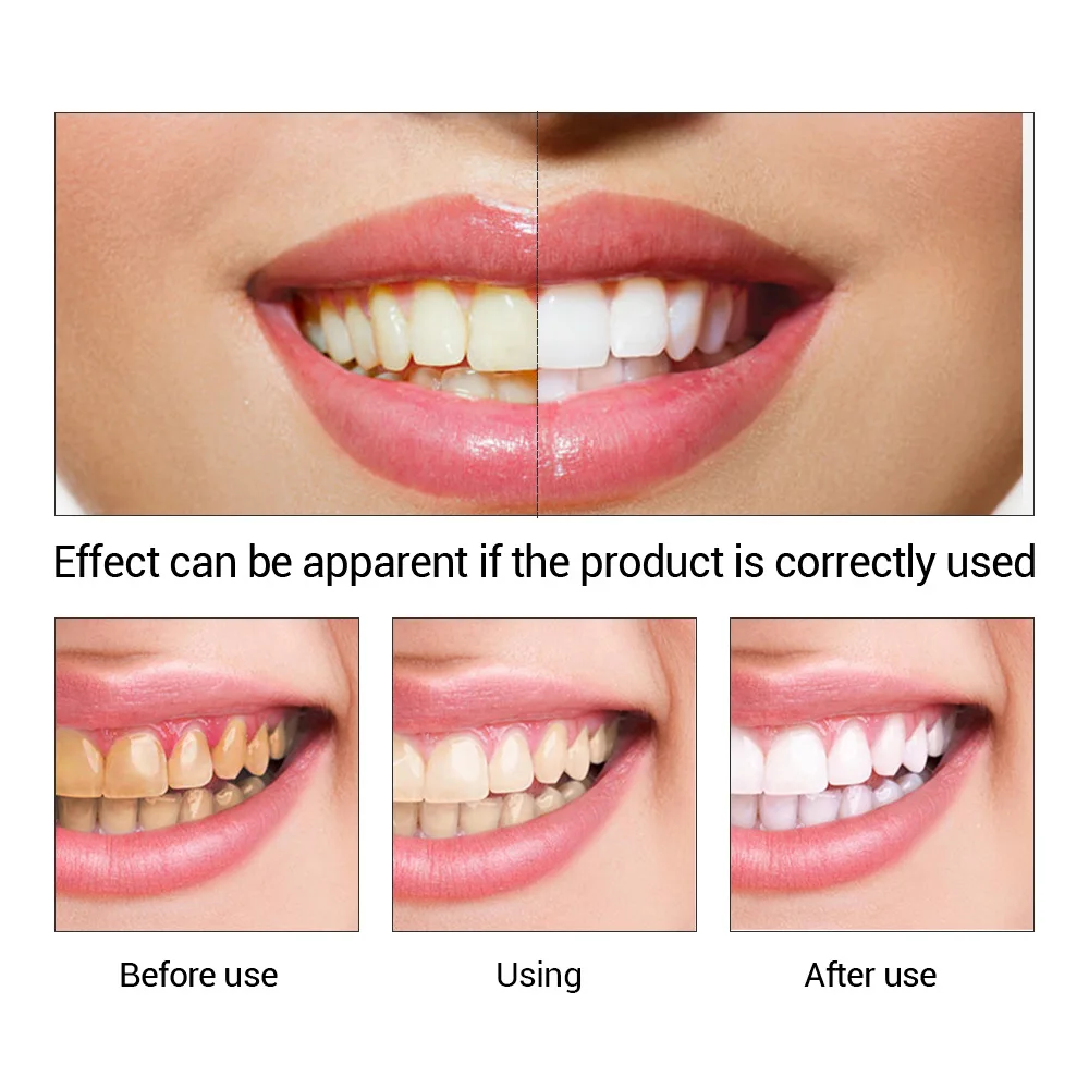 FTEENPLY Sbiancamento Dei Dent - Teeth Whitening China recensione e prezzo