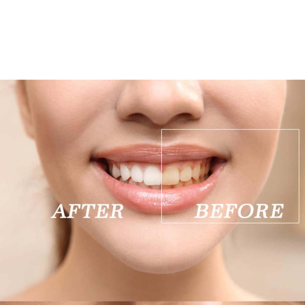 Kit gel sbiancante per denti c - Teeth Whitening Led Kit recensione e prezzo