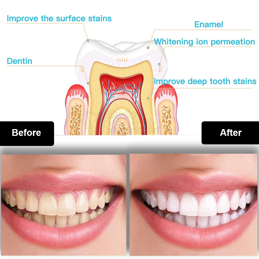 Kit per sbiancamento dei denti - Teeth Whitening Led Kit recensione e prezzo