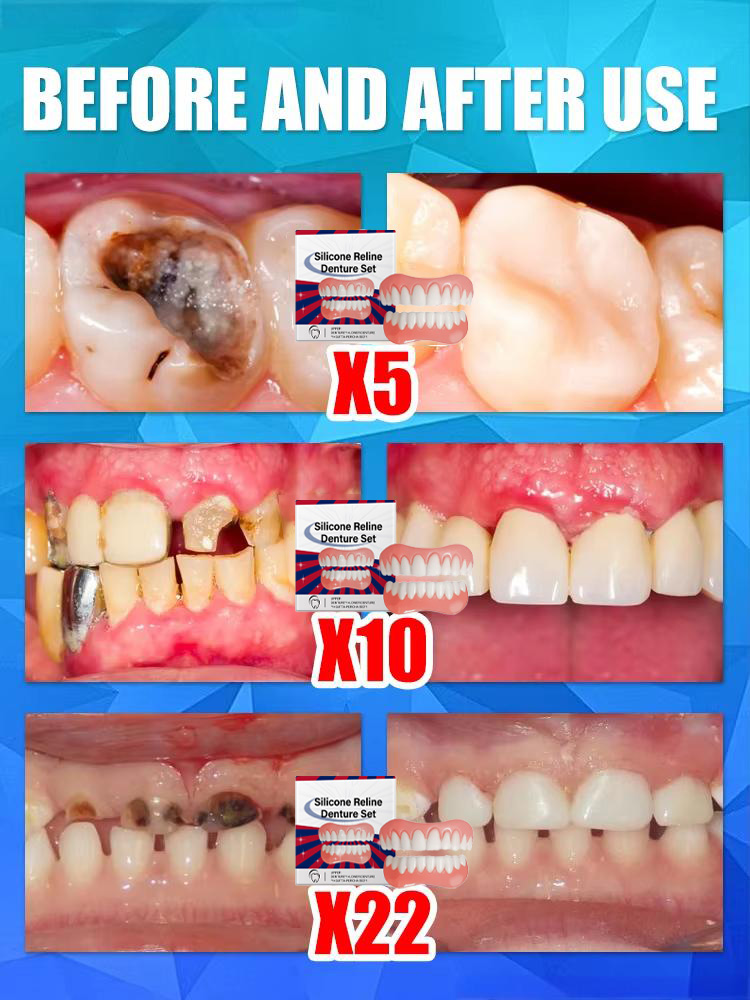 Denti finti Impiallacciature s - Teeth Whitening With Braces recensione e prezzo